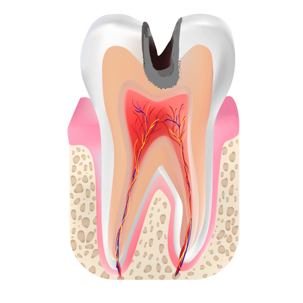 虫歯c3